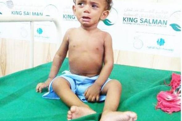 بدعم «سلمان للإغاثة».. 61584 مستفيداً من دعم التغذية للأطفال والأمهات الحوامل في اليمن