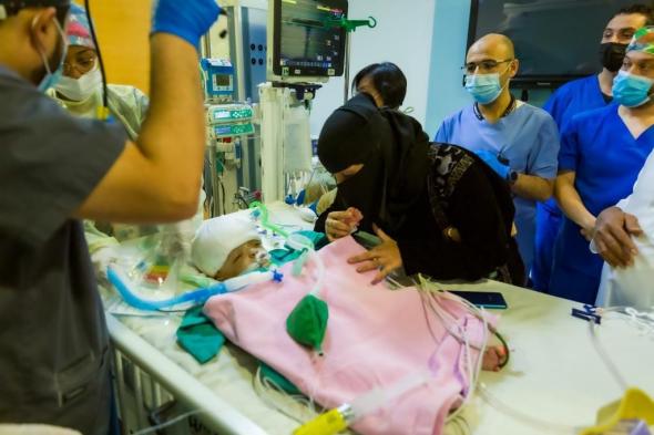 نجاح فصل التوأم السيامي اليمني يوسف وياسين بعد عملية 15 ساعة