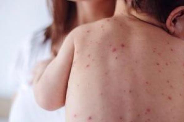 أزمة
      صحية
      فى
      إسرائيل..
      وفاة
      15
      طفلاً
      بسبب
      تفشى
      الحصبة