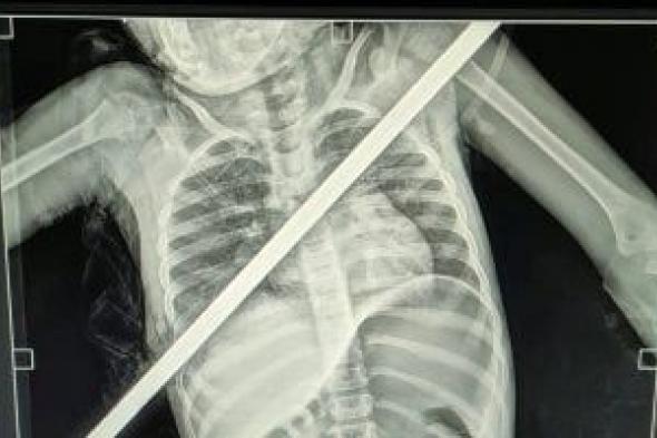 3
      ساعات
      فى
      العمليات..
      إنقاذ
      حياة
      طفلة
      اخترق
      سيخ
      حديد
      صدرها
      فى
      بنها
      الجامعى